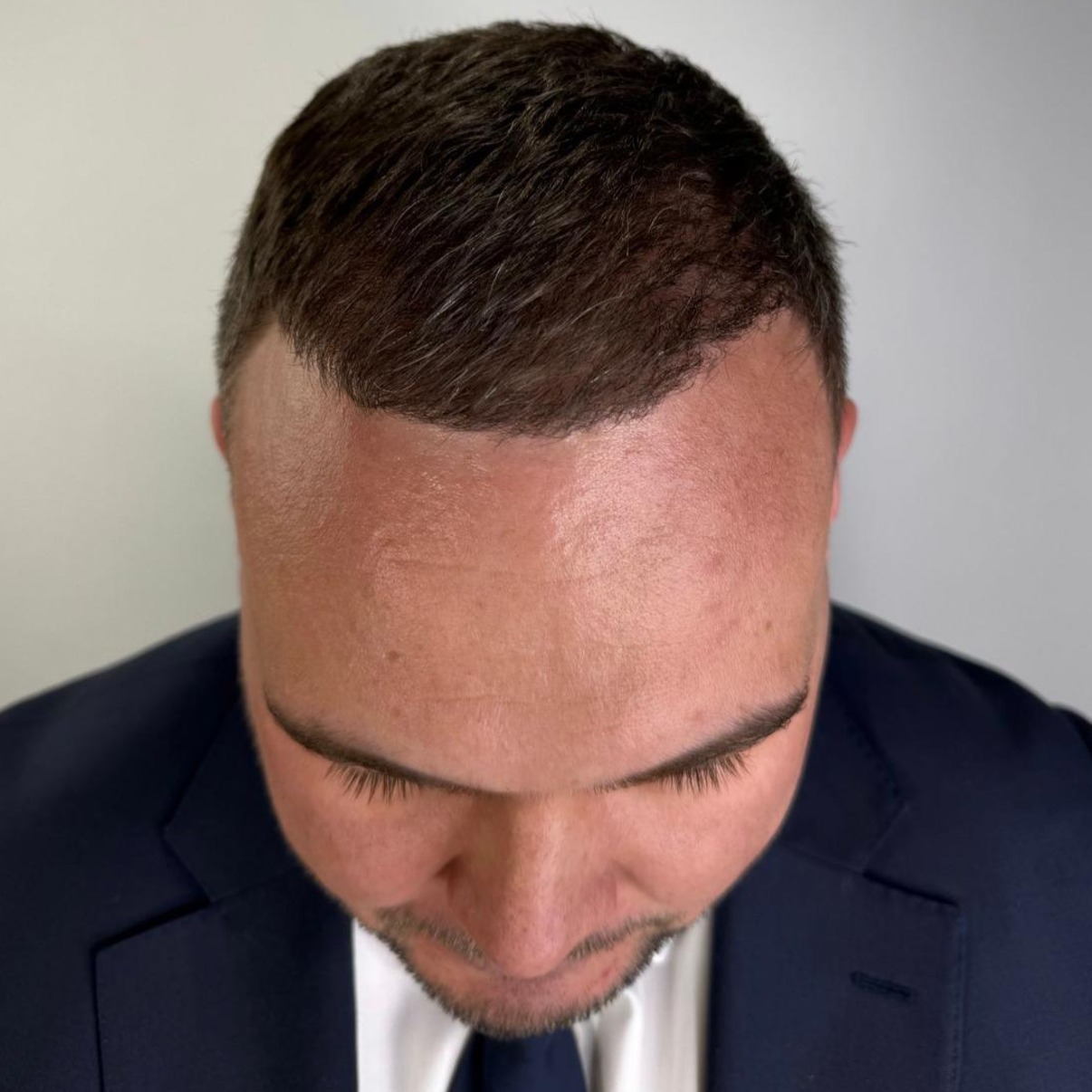 Hairline restoration after treatment, frontal view