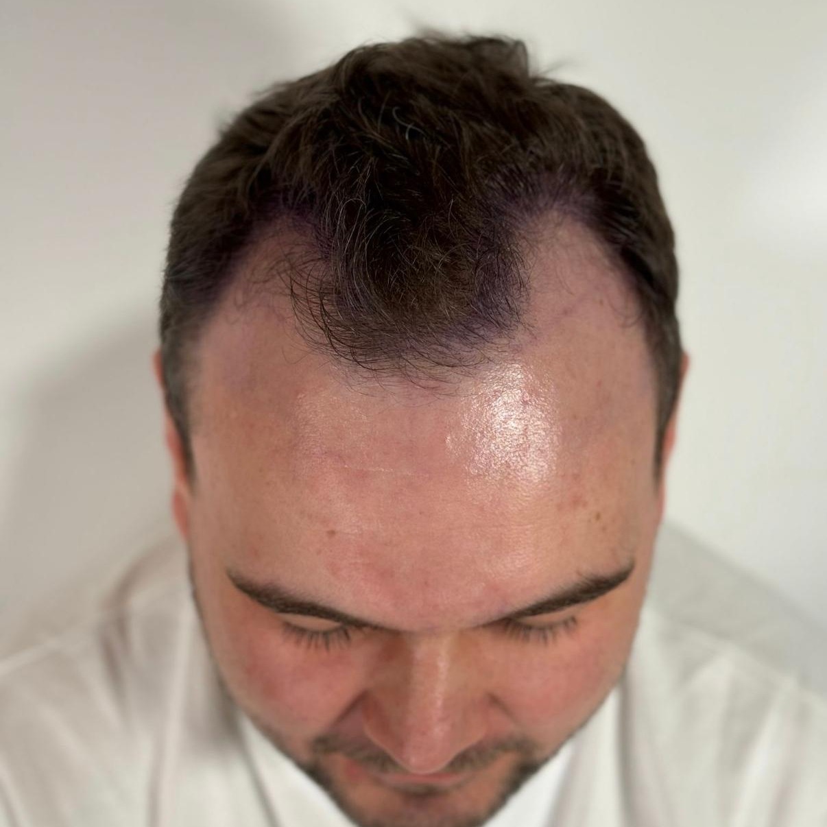 Hairline restoration before treatment, frontal view
