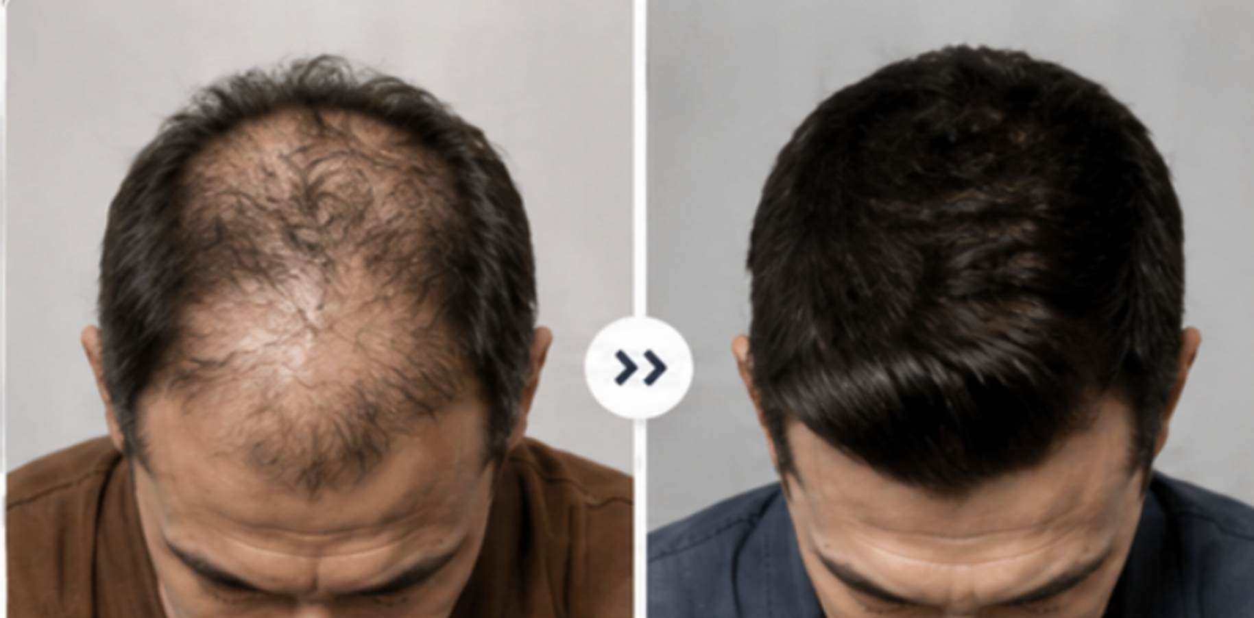 Patient before and after hair restoration result